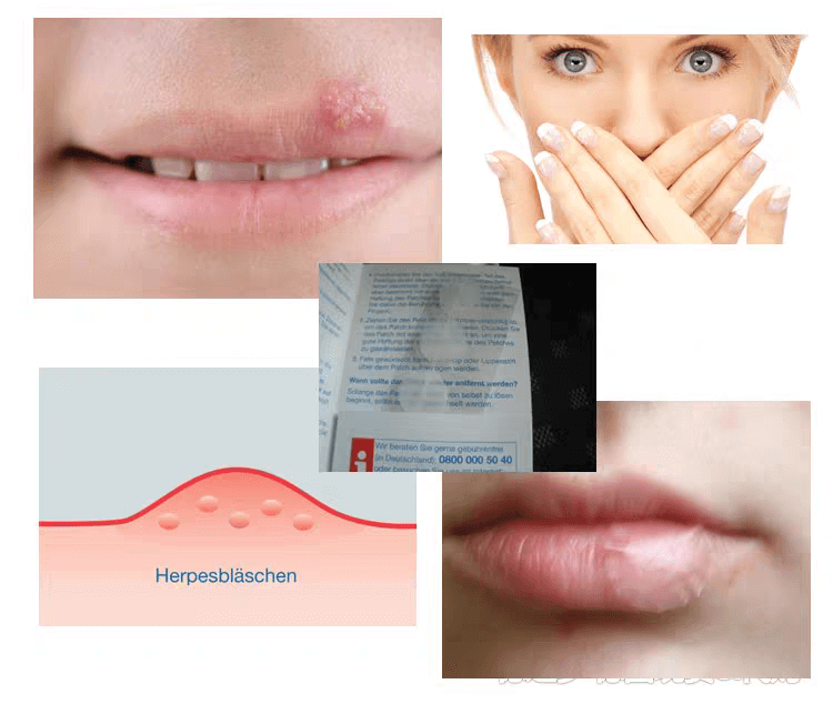 德國sos唇皰疹貼片1704247531371596.png 德國sos唇皰疹貼片