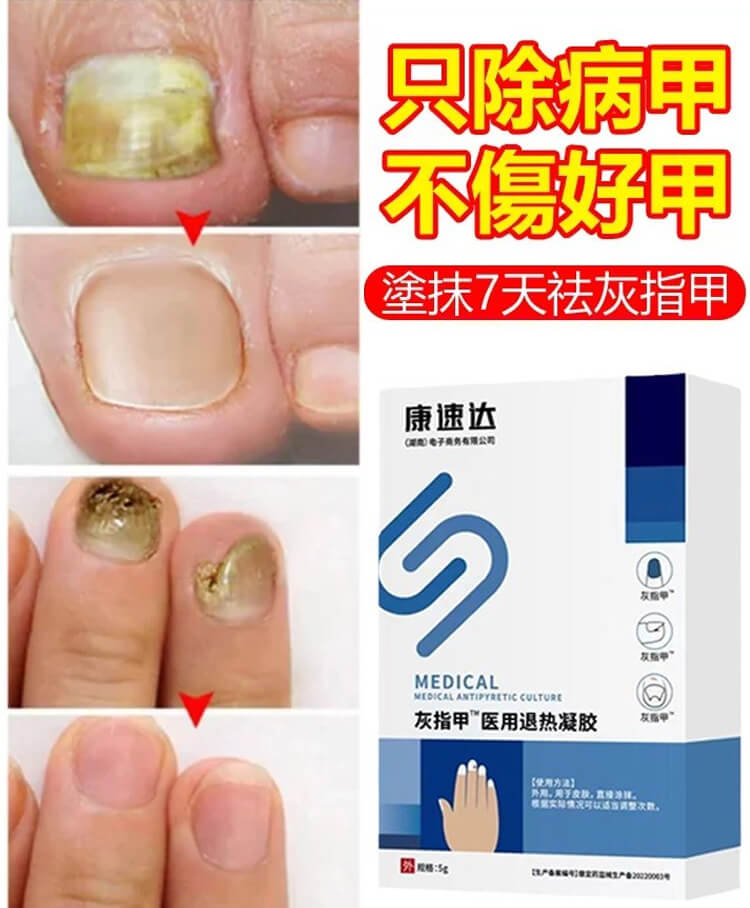 康速達灰指甲醫用退熱凝膠